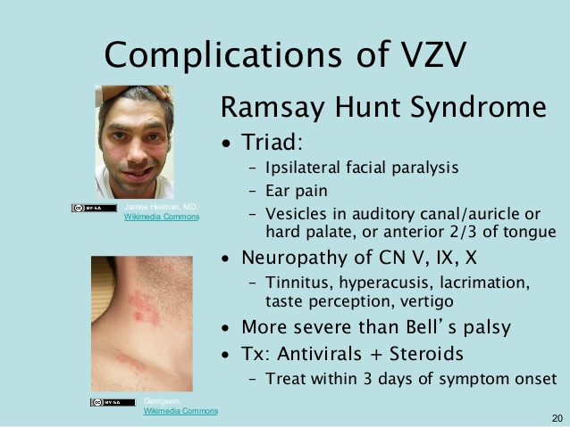 Ramsay-Hunt-Syndrome-complications.jpg
