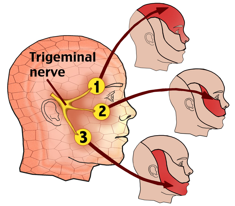 Trigeminal-Neuralgia.jpg
