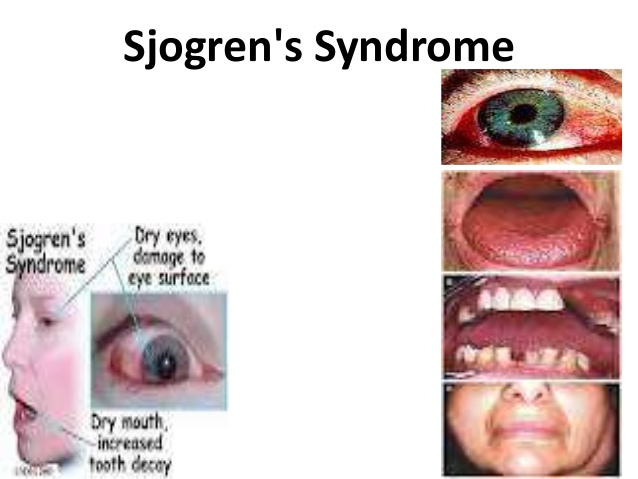 sjogrens-syndrome-1-638.jpg