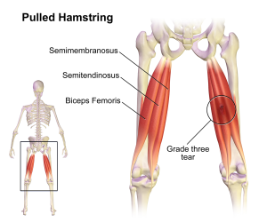 Pulled_Hamstring_20160712202729a54.png